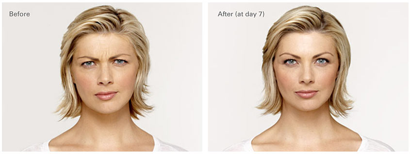 Before and After Botox Photos Dermatology Associates of the TriCities