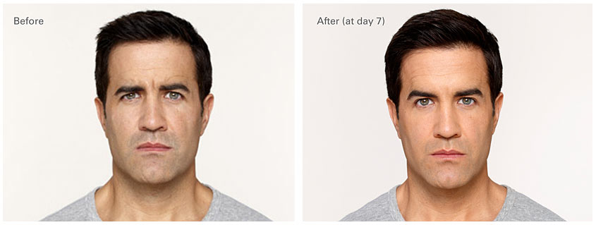botox photo of men Dermatology Associatesof the Tricities
