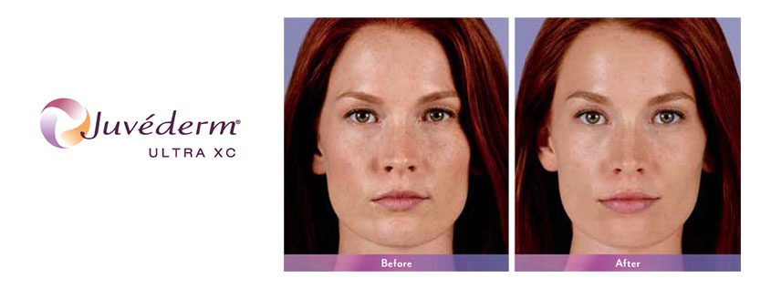 Juverderm treatment Bristol, Kingsport, Johnson City, Dermatology Associates of the Tricities