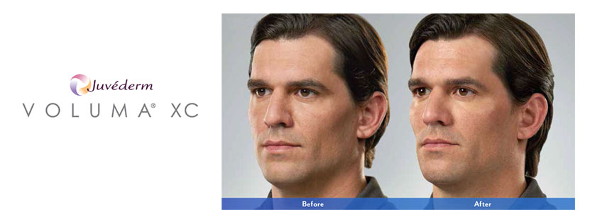 Juverderm treatment Bristol, Kingsport, Johnson City, Dermatology Associates of the Tricities