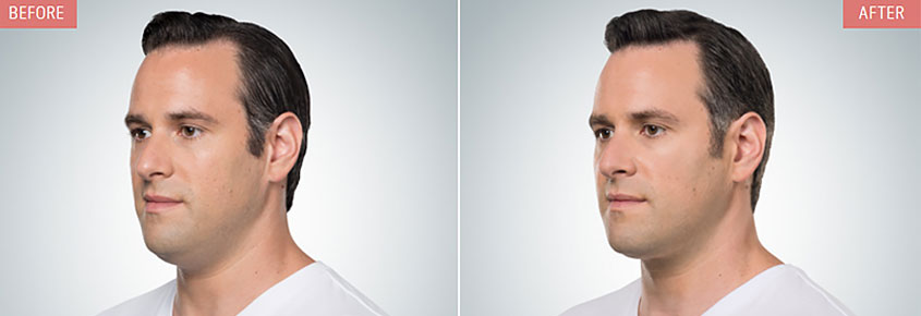 Botox Cosmetics are provided by the Dermatology Associates of the TriCities Cosmetic Center