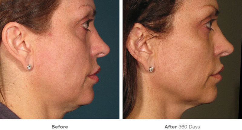 Botox Cosmetics are provided by the Dermatology Associates of the TriCities Cosmetic Center