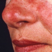 Treatment for Rosacea - Dermatology Associates