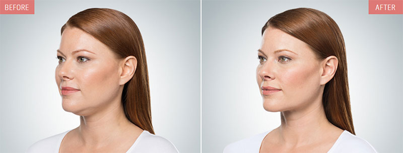 KYBELLA®