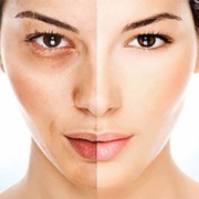 Melasma Treatment & Triggers - Dermatology Associates