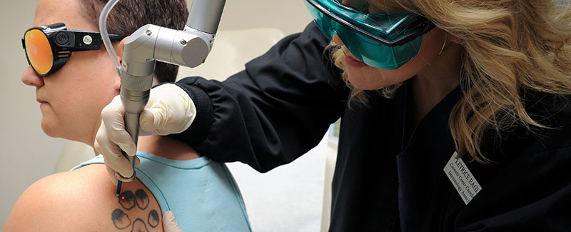 Tattoo Removal