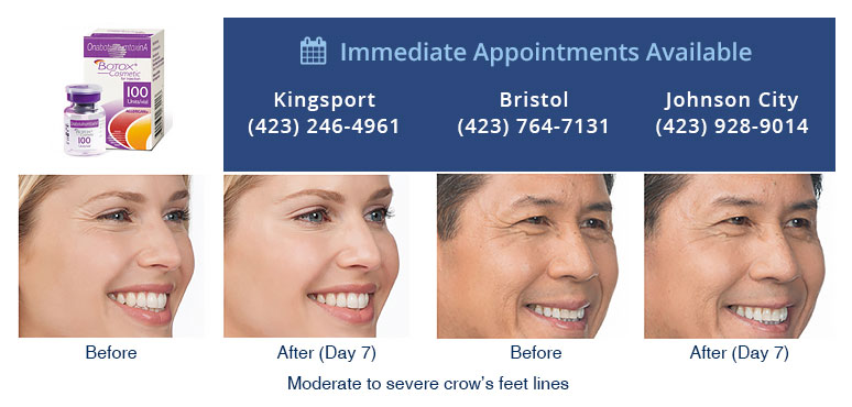BOTOX® Cosmetic