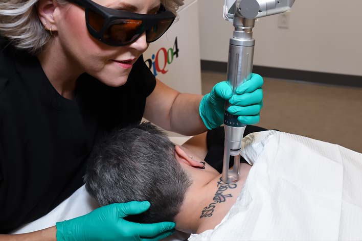 Tatoo Removal