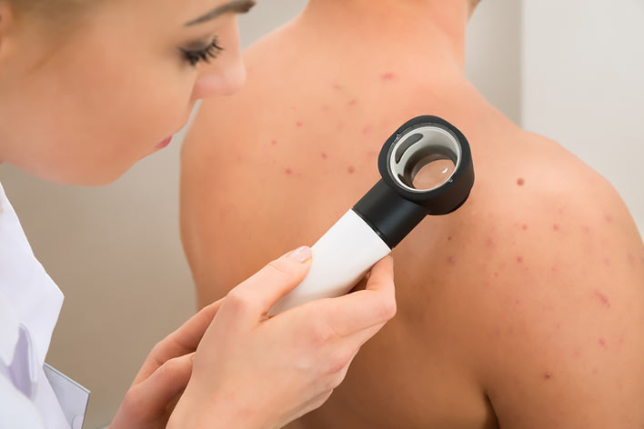 Skin Cancer